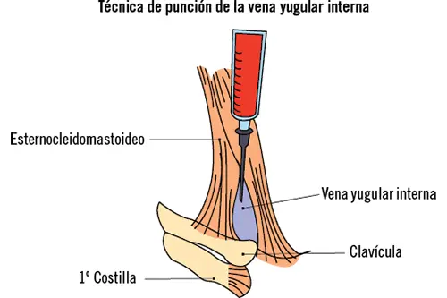 Técnica de punción de la vena femoral Para la correcta realización de esta - фото 15