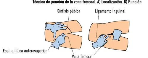 Complicaciones en las punciones de las vías centrales Como principales - фото 16