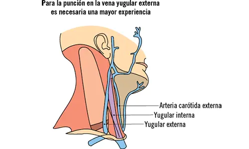 La punción de la vena yugular externa se realizará con el paciente en posición - фото 6