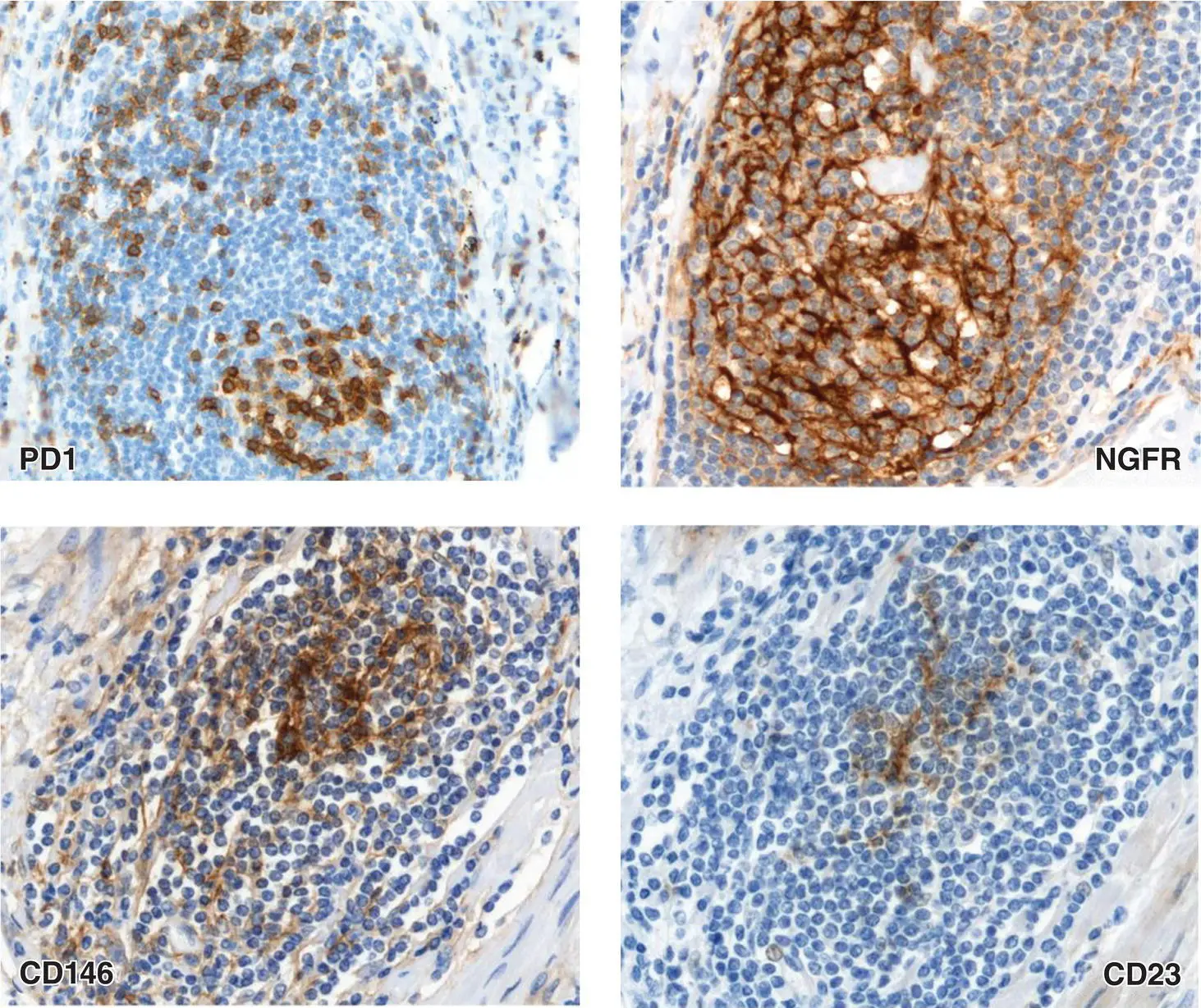 Figure 12 Representative immunohistochemical staining for PD1 upper left and - фото 5