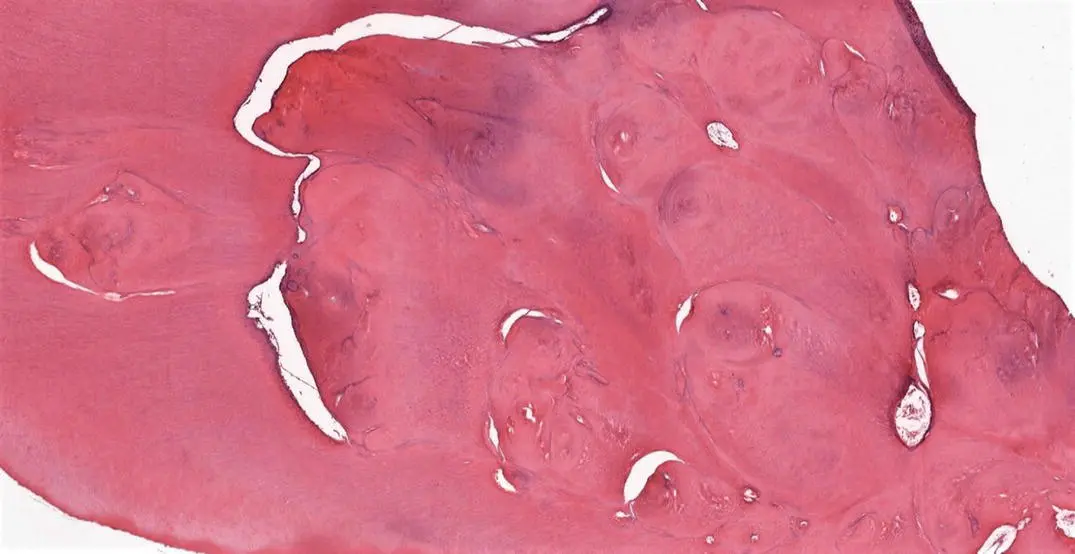 Figure 116H and E stained decalcified section showing DD with the typical - фото 19