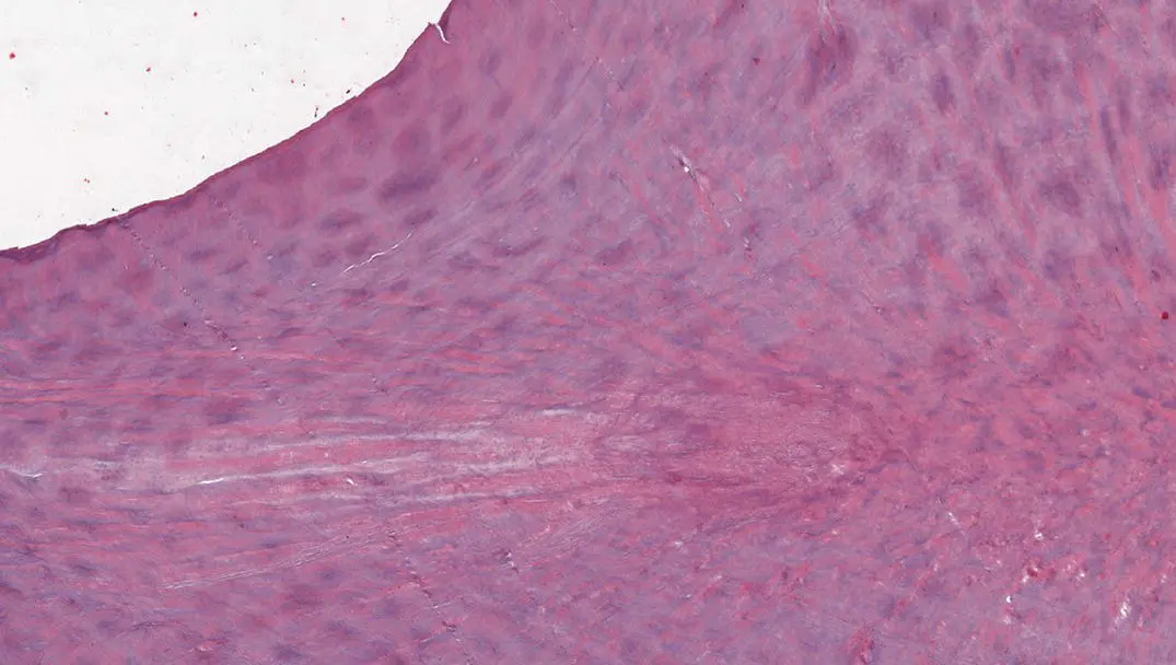 Figure 114H and E stained decalcified section showing DI with a haphazard - фото 17