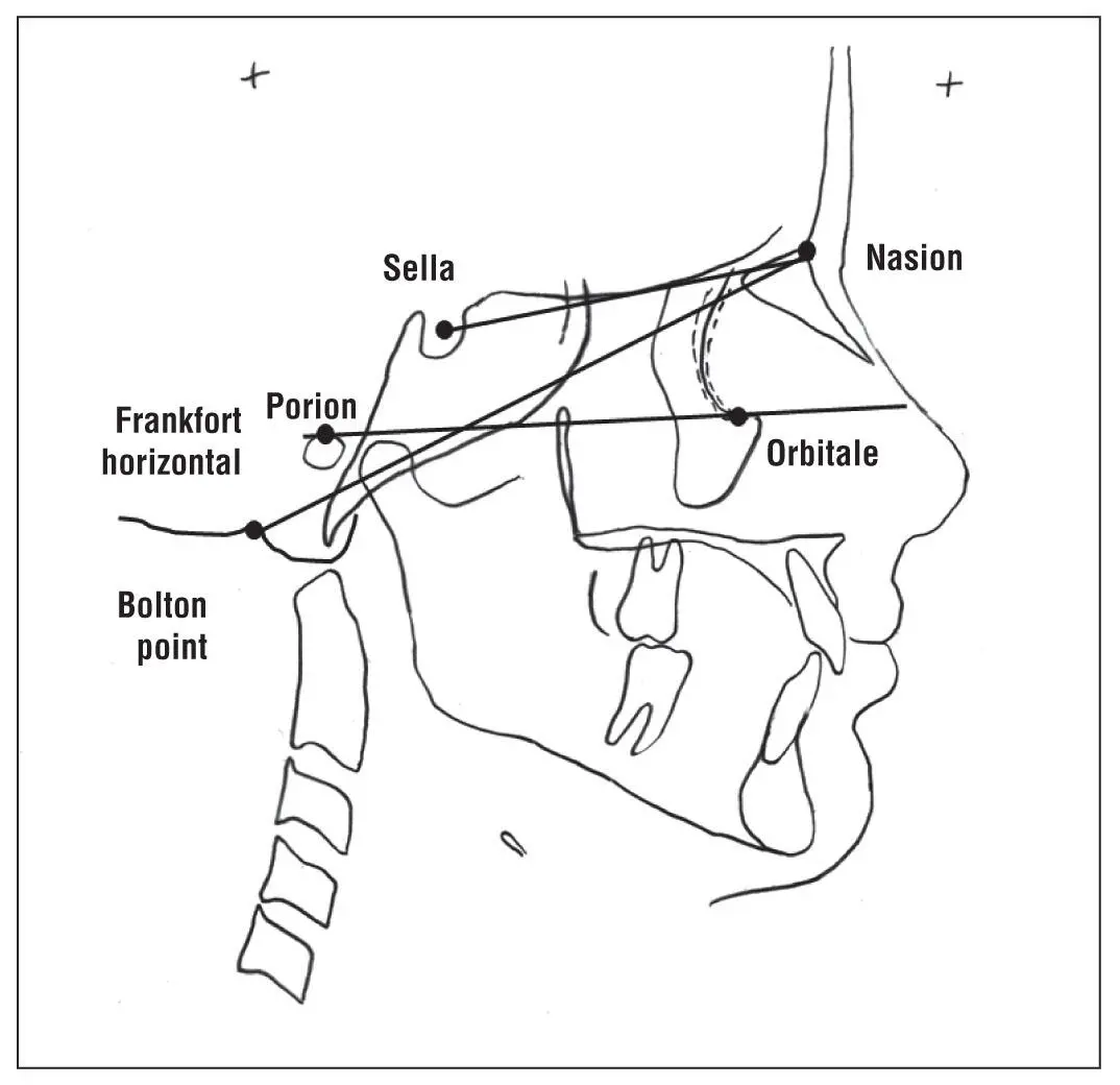 Fig 17Sellanasion Frankfort horizontal and Boltonnasion reference planes - фото 9