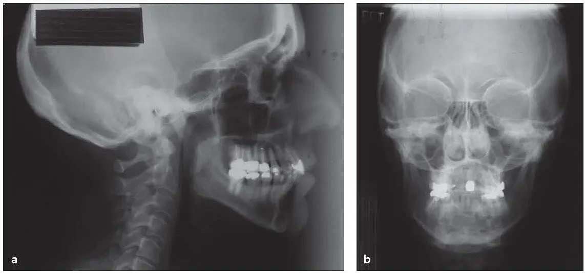 Fig 24Examples of filmbased lateral a and PA b cephalograms Darkroom - фото 13
