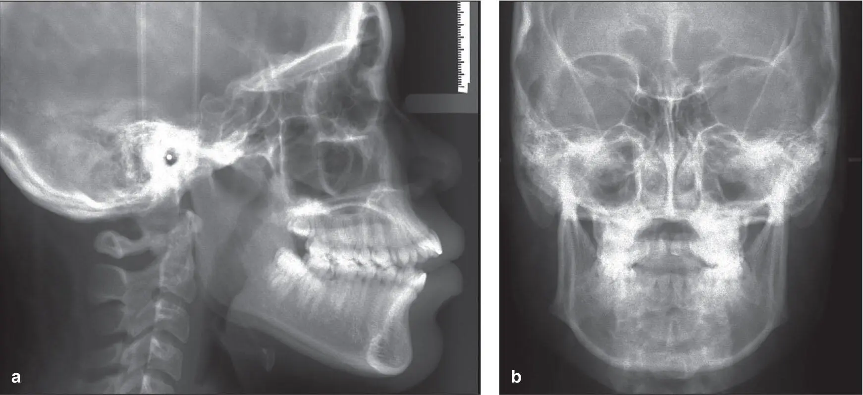 Fig 11 a and b Lateral and frontal cephalograms In addition cephalograms - фото 3