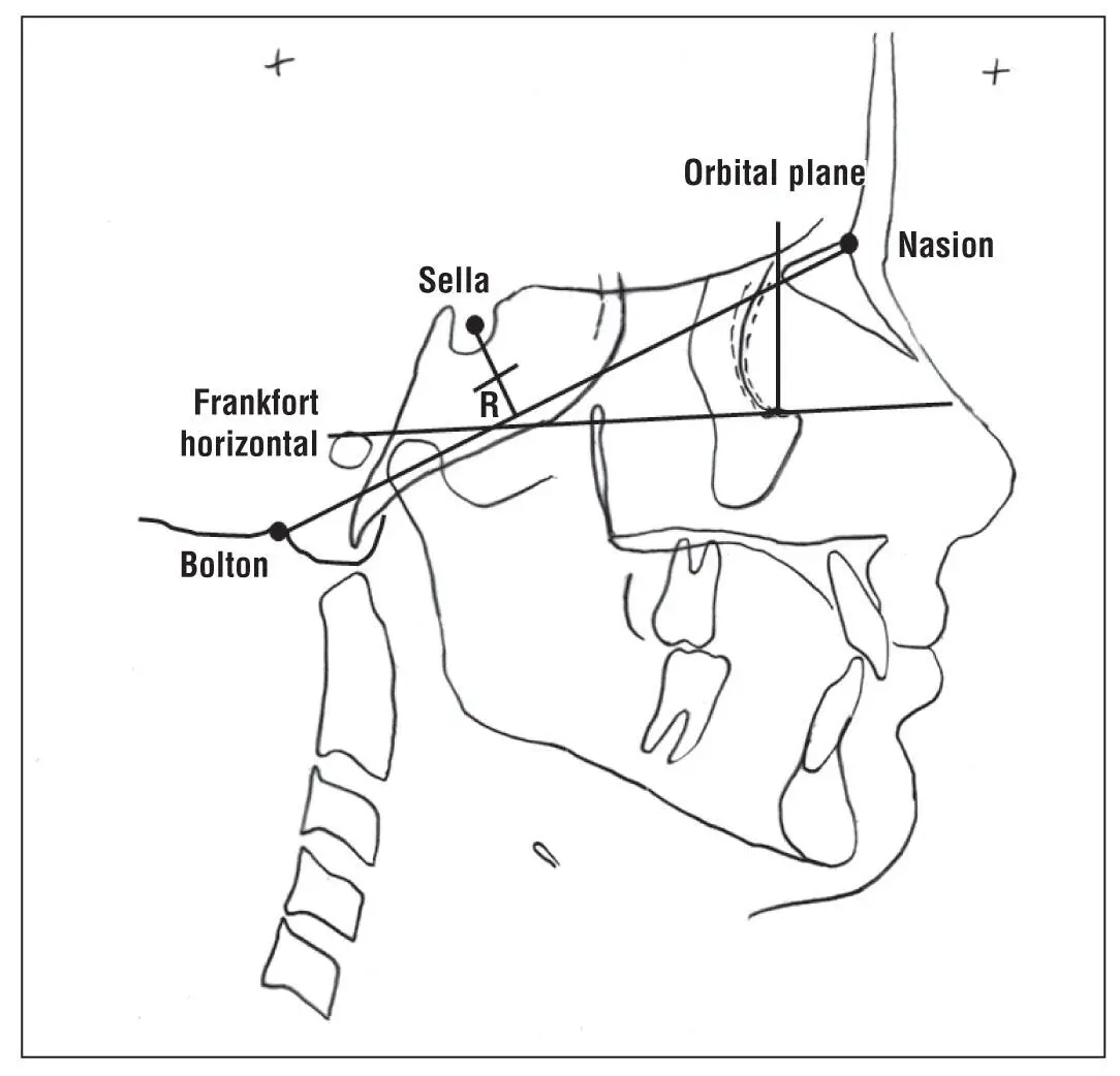 Fig 16Boltonnasion plane of orientation and registration point R in the - фото 8