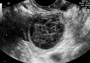 Figura 1662Endometrioma Figura 1663Endometrioma - фото 127