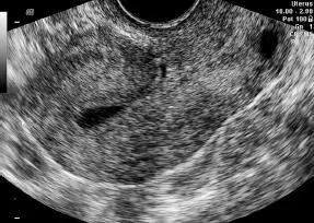 Evaluación endometrial cualitativa Consiste en la evaluación descriptiva del - фото 105