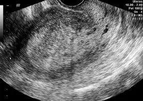 Figura 1657Pared endometrial mal definida heterogénea Patología maligna - фото 122