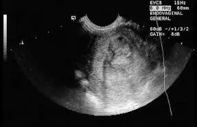 Figura 1625Posthisterosonografia de irregularidad pared endometrial Figura - фото 90