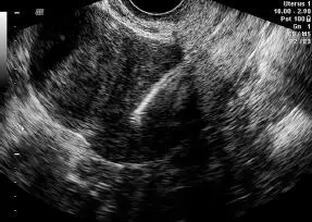 Adenomiosis Es la presencia de tejido endometrial estromas y glándulas en el - фото 114
