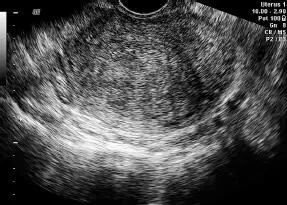 Leiomiosarcoma Los sarcomas son de baja frecuencia menos del 1 de las - фото 116