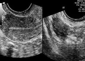 Figura 1641Endometrio trilaminar tipo 1 ovario con folículo dominante - фото 106