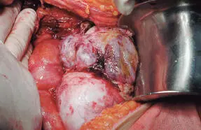 Figura 1520Aspecto microscópico de un carcinoma seroso de alto grado del - фото 60