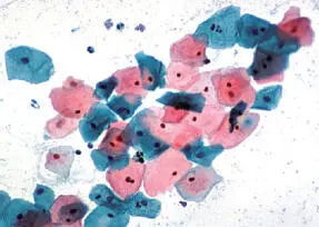 Figura 1511Microfotografía de una citología alterada representativa de una - фото 51