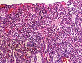 Adenocarcinoma mucinoso tipo intestinal Presentan patrones morfológicos - фото 48