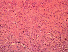 AdenomiomaEs un tumor bien circunscrito benigno compuesto por glándulas de - фото 50
