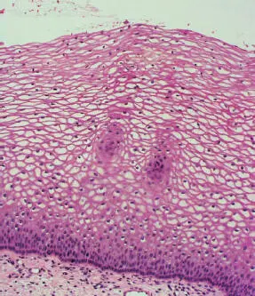 Neoplasia intraepitelial con displasia leve NIE Idisplasia epitelial leve - фото 44