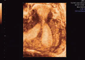 Figura 1654Vascularización de pólipo Hiperplasia endometrial Corresponde a - фото 119