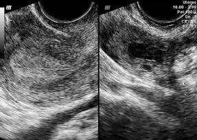 Endometrio tipo IIIPierde su estructura trilaminar Es homogéneamente - фото 109