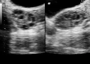 Figura 1637Ovario con folículo vía transvaginal Tabla - фото 102
