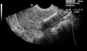 Figura 1646Desviación DIU extremo distal hacia el OCI Se debe verificar que - фото 111