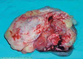 Teratoma inmaduroCorresponde a un teratoma con componente de tejido inmaduro y - фото 64