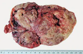 Tumor de células de la granulosa juvenilCorresponde a 5 de los tumores de - фото 66