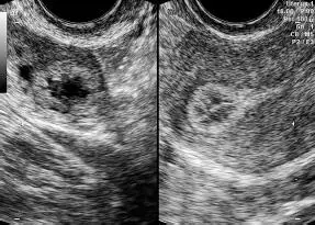 Figura 1643Endometrio refringente tipo 3 ovario con cuerpo lúteo - фото 108