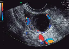Figura 1661Cuerpo lúteo hemorrágico Figura 1662Endometrioma - фото 126