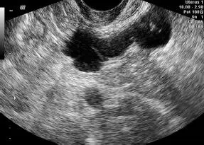 Embarazo ectópicoLa ecografía transvaginal es el método diagnóstico de - фото 143