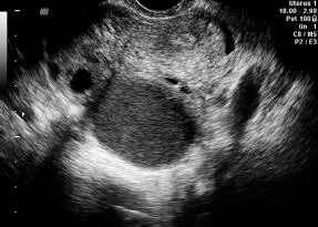 Figura 1663Endometrioma Figura 1664 Kissing ovaries - фото 128