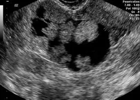 Otros Síndrome ovarios poliquísticosno corresponde a un tumor anexial a - фото 139