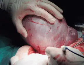 Tumor seroso proliferativo atípico o tumor seroso borderline a diferencia - фото 59