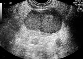 Figura 1664 Kissing ovaries Figura 1665ATO compromiso trompas - фото 129
