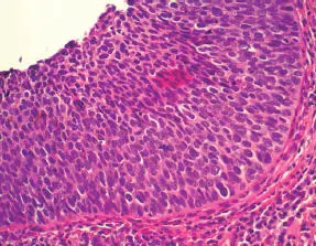 Carcinoma escamosoes poco frecuente Histológicamente es similar al - фото 53