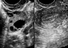 Figura 1642Endometrio trilaminar tipo 2 ovario con cuerpo lúteo Figura - фото 107