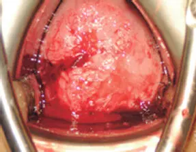 Figura 156Aspecto microscópico de un cáncer invasor de cuello uterino - фото 46