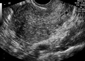 Figura 1650Adenomiosis Corte transverso Leiomiosarcoma Los sarcomas son - фото 115