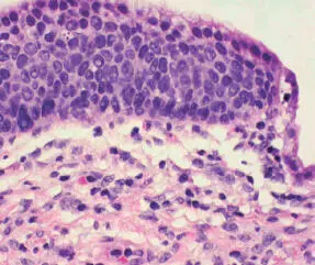 3 Carcinoma in situ CISla displasia epitelial intensa compromete el total - фото 45