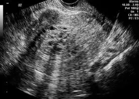 Figura 1656Hiperplasia endometrial Figura 1657Pared endometrial mal - фото 121