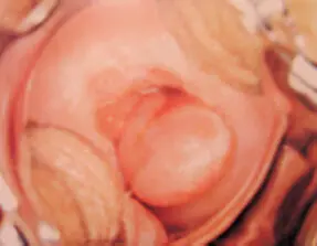Lesiones precursoras del carcinoma cervicouterinoson lesiones puramente - фото 43