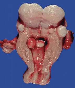 Figura 159Aspecto microscópico de un leiomioma uterino AdenomiomaEs un - фото 49