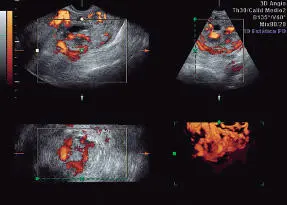 INDICACIONES DE ULTRASONOGRAFÍA GINECOLÓGICA 1 Examen físico insuficiente o - фото 97