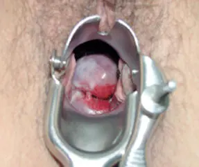 Pólipo endocervicalpor lo usual es un pólipo pequeño único asintomático - фото 42