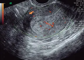 Hiperplasia endometrial Corresponde a una patología con afectación difusa - фото 120