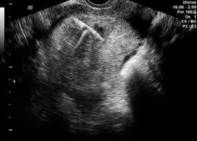 Se debe verificar que el dispositivo intrauterino se visualice en el centro de - фото 112