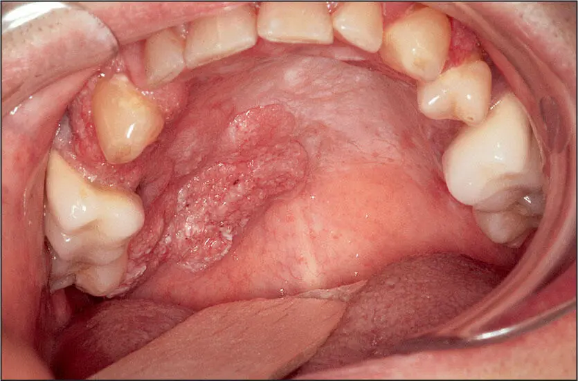 Widespread surface involvement of dysplasiacarcinoma in situ and invasive - фото 53
