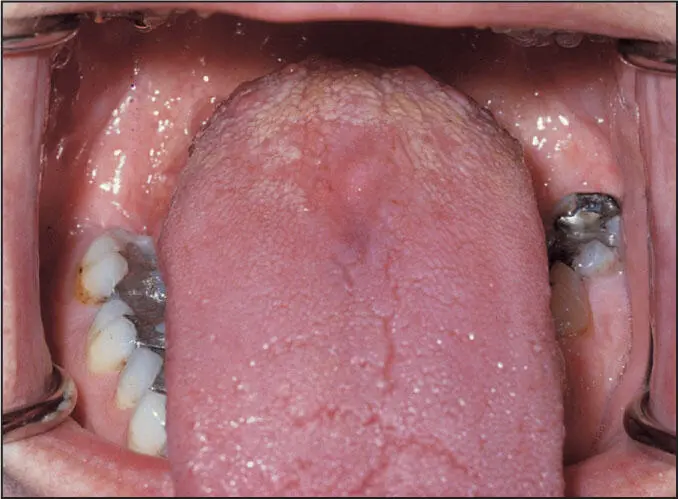 Median rhomboid glossitis - фото 43