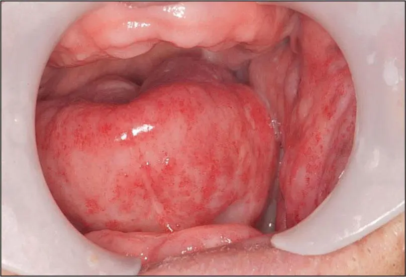 Acute radiation mucositis - фото 49